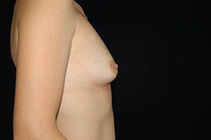 Breast Augmentation 5c